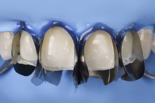 Unica anterior Introkit - Image 2